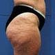 the stage of cellulite