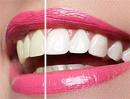 teeth whitening