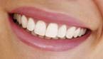 teeth whitening